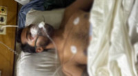 Nur in ICU with severe injuries after police action