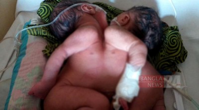 বুক-পেট জোড়া লাগানো সেই জমজ ২ শিশু হাসপাতালে