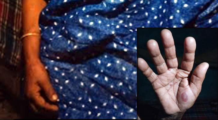 চুয়াডাঙ্গায় মাঙ্কিপক্স উপসর্গ নিয়ে হাসপাতালে নারী