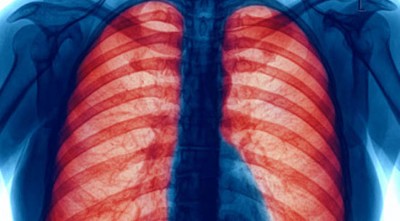 প্রথমবারের মতো ফুসফুসের রোগে আক্রান্তদের জন্য আসছে পিল!  