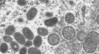 মাঙ্কিপক্স আতঙ্ক নয়, সতর্কতা প্রয়োজন